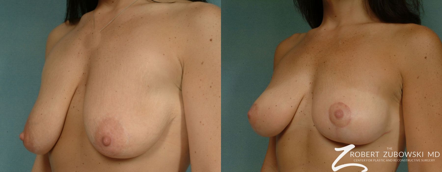 Breast Lift - Thumbnail 2