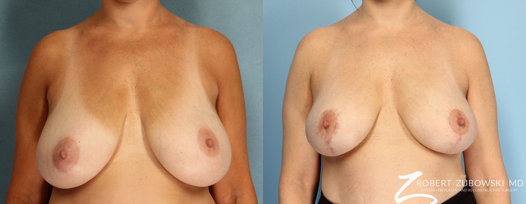 Breast Lift and Augmentation - Case 3666