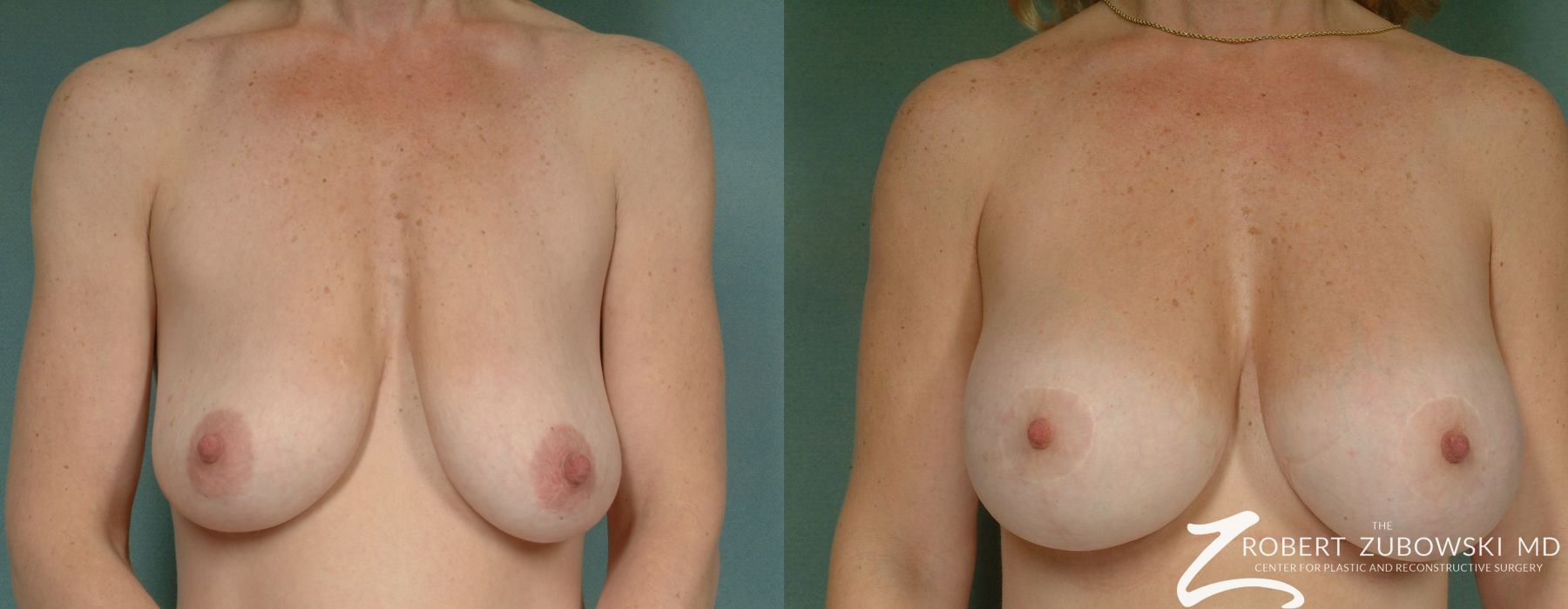 Breast Lift and Augmentation - Case 3672