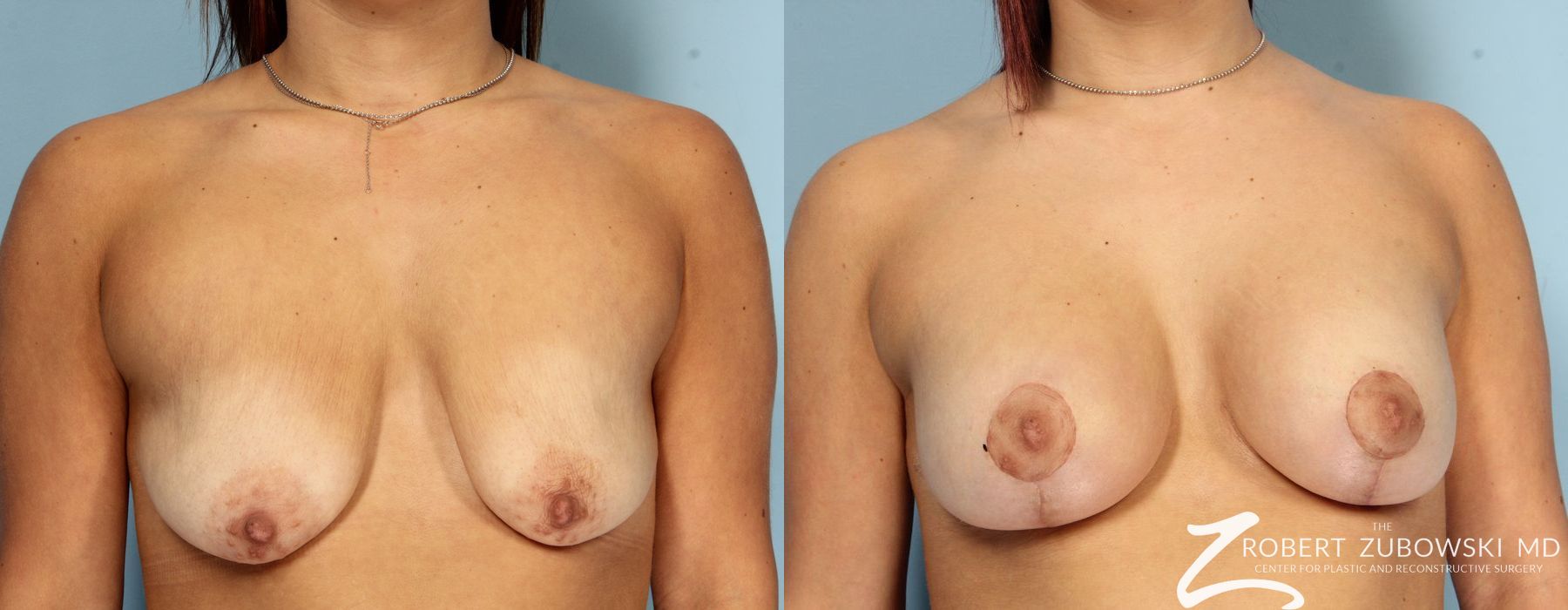 Breast Lift and Augmentation - Case 3681