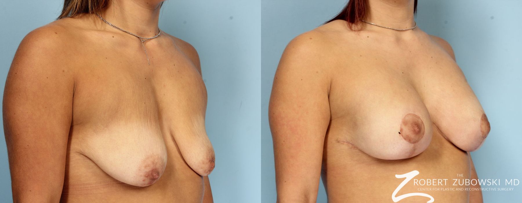 Breast Lift and Augmentation - Thumbnail 2