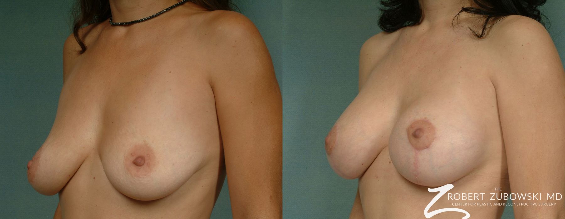 Breast Lift and Augmentation - Thumbnail 2