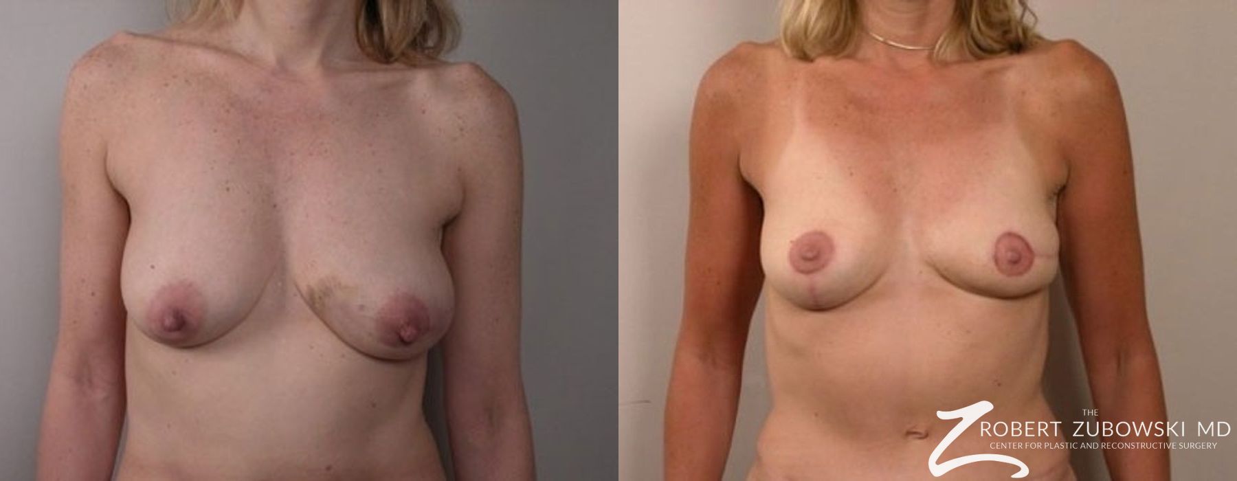 Breast Reconstruction - Case 4383