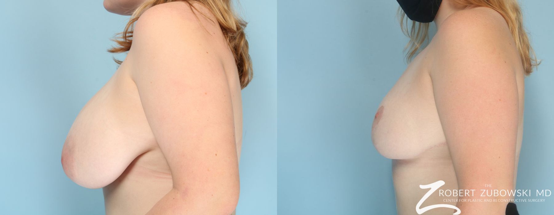 Breast Reduction - Thumbnail 2