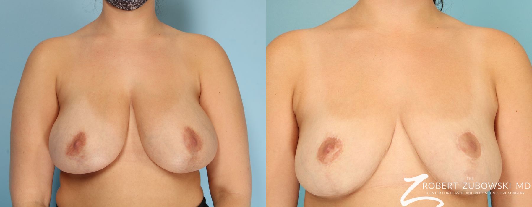 Breast Reduction - Case 3709