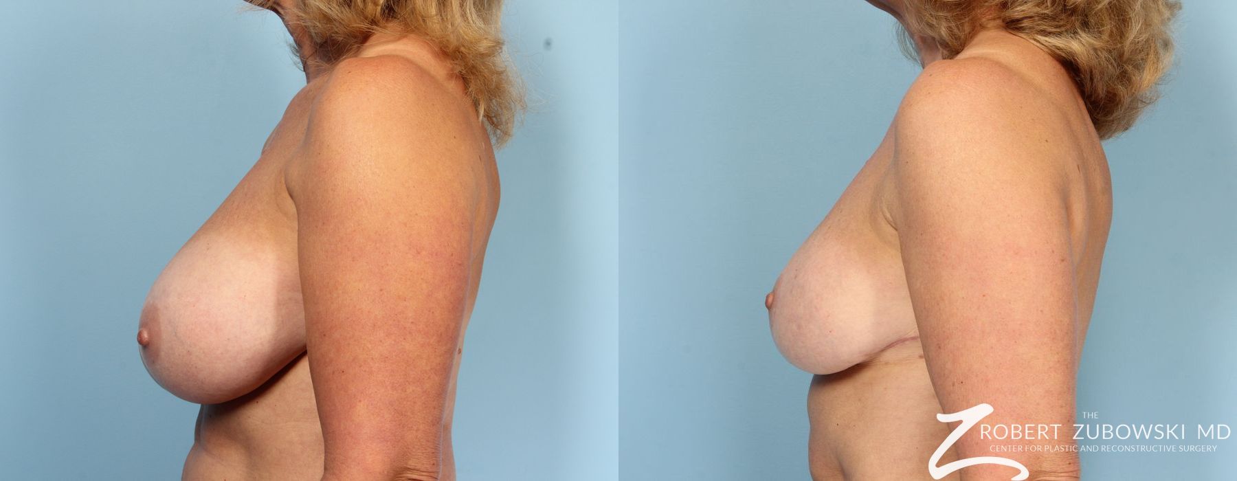 Breast Reduction - Thumbnail 4