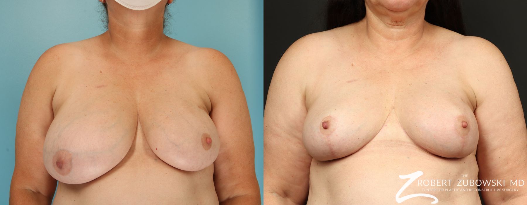 Breast Reduction - Case 4165