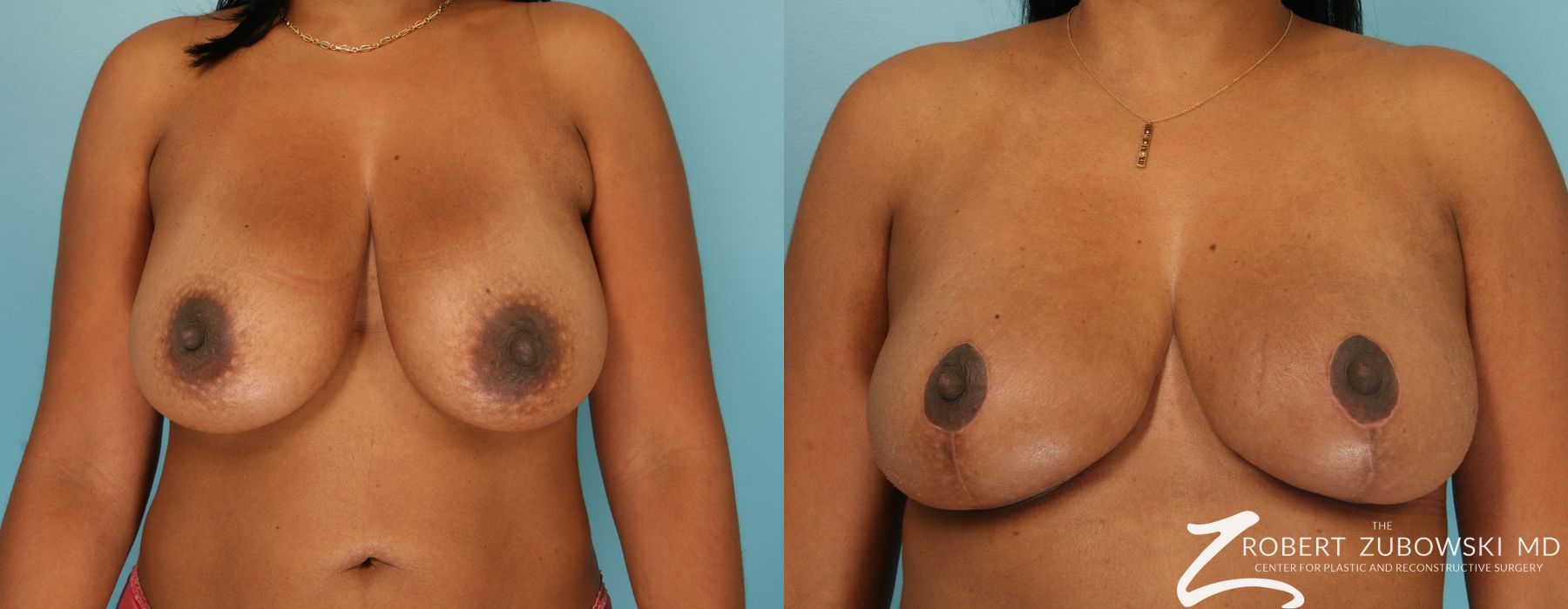 Breast Reduction - Case 3712
