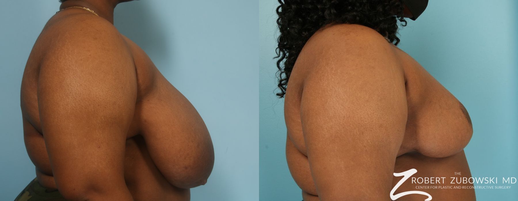 Breast Reduction - Thumbnail 2