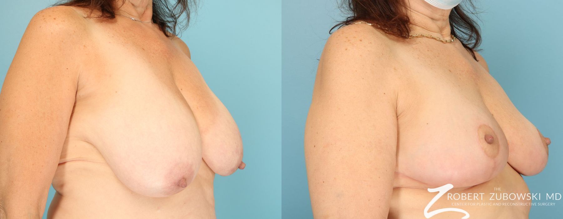 Breast Reduction - Thumbnail 3
