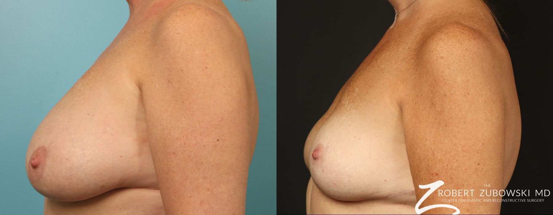 Breast Reduction - Thumbnail 2