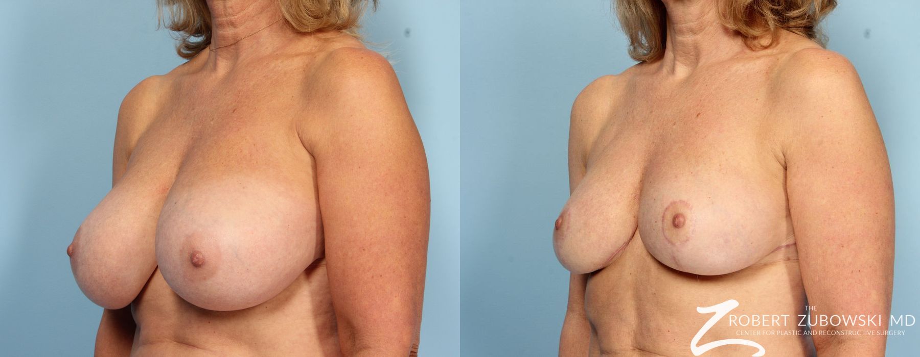 Breast Reduction - Thumbnail 3