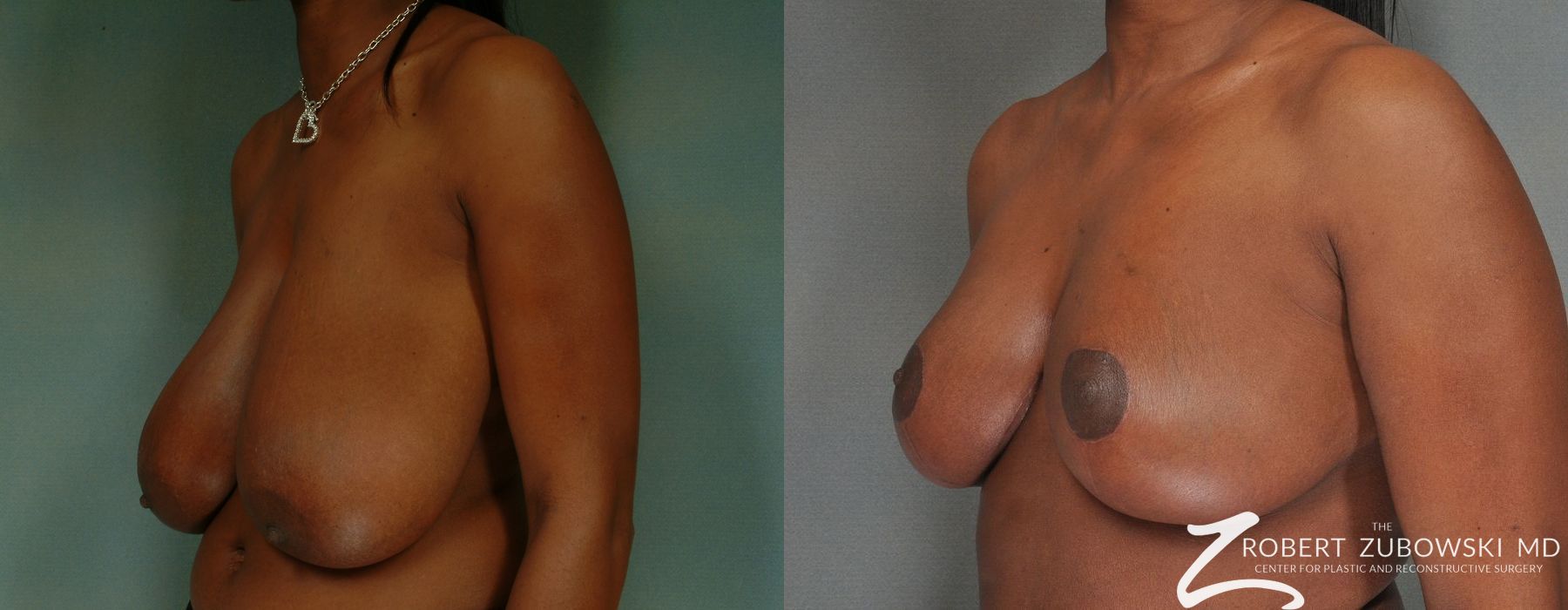 Breast Reduction - Thumbnail 2