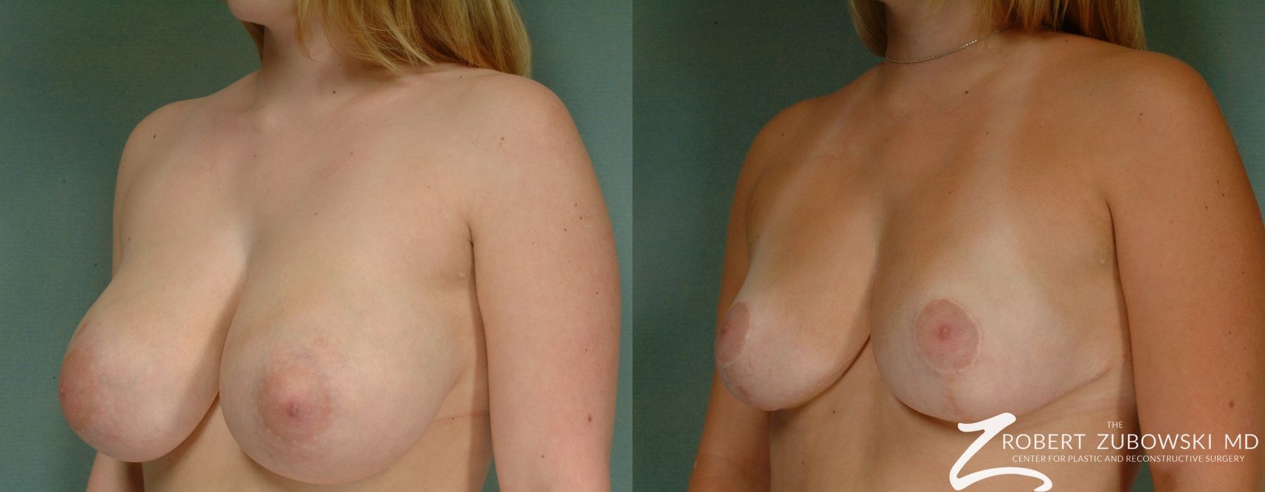 Breast Reduction - Thumbnail 2