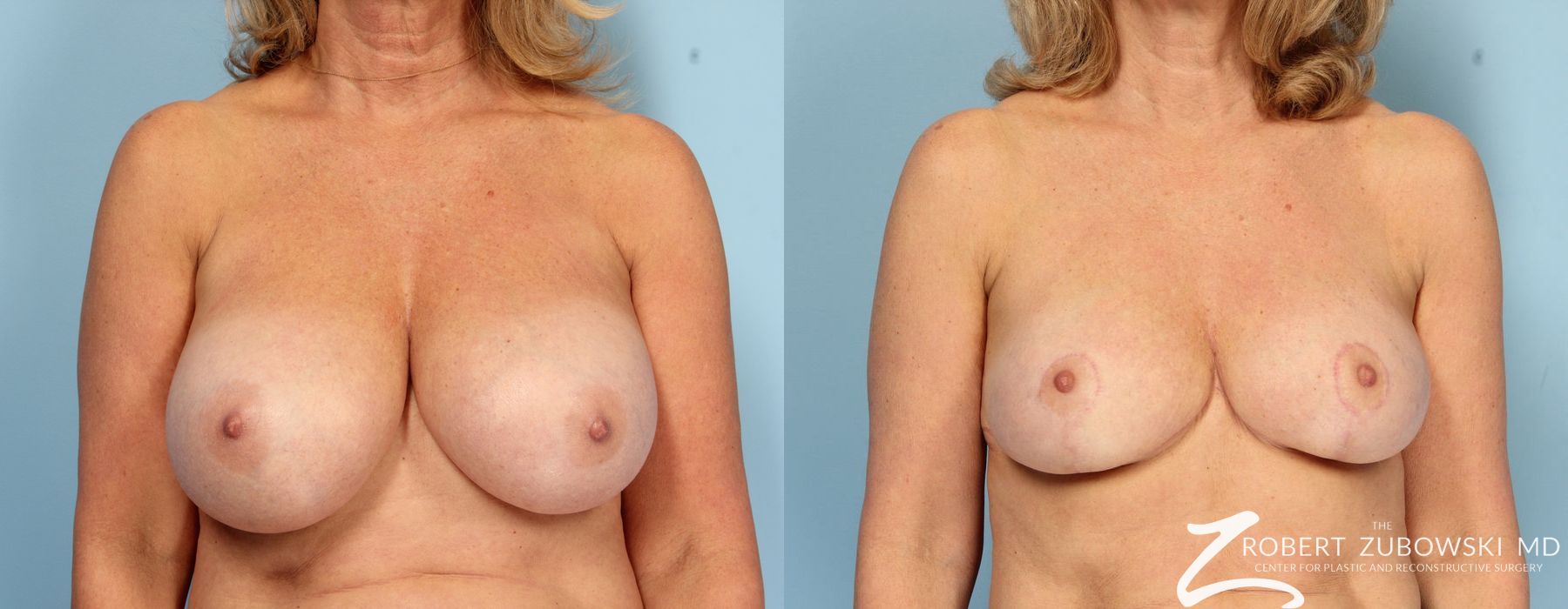 Breast Reduction - Case 3707