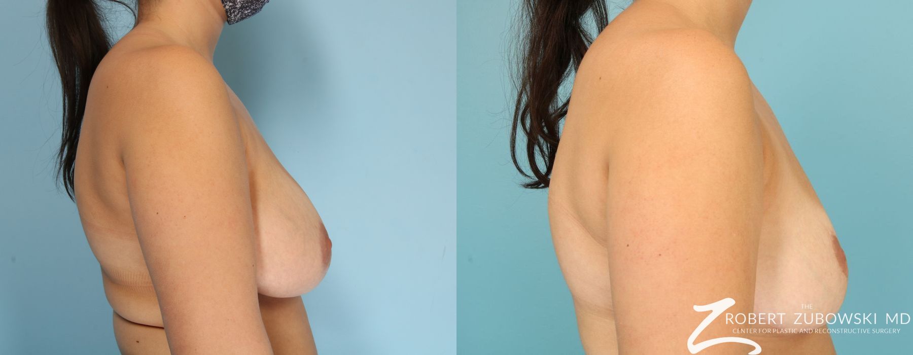 Breast Reduction - Thumbnail 2