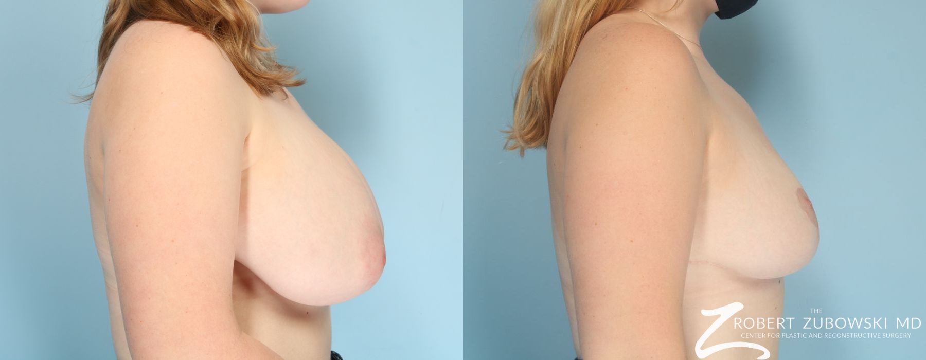 Breast Reduction - Thumbnail 3