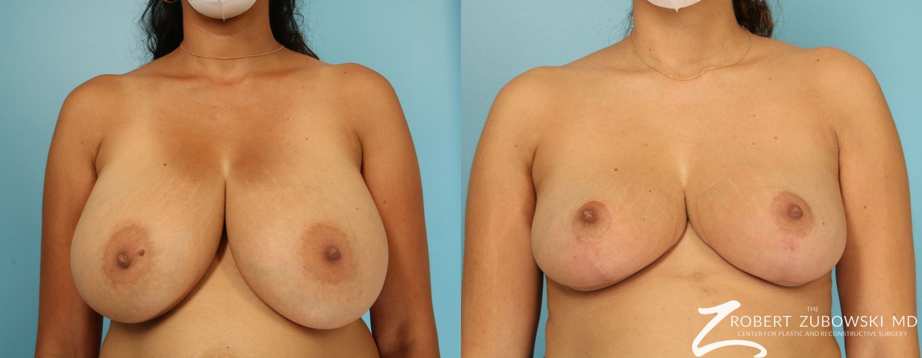 Breast Reduction - Case 3711