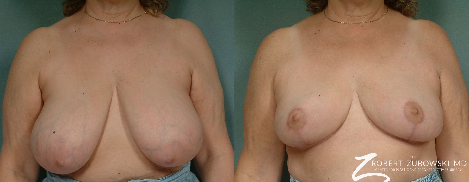 Breast Reduction - Case 3700