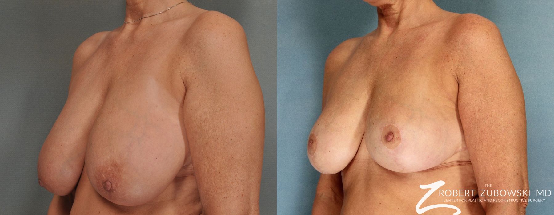 Breast Reduction - Thumbnail 2