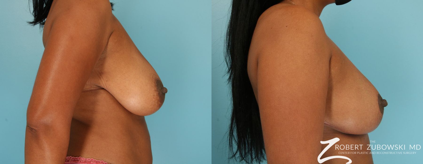 Breast Reduction - Thumbnail 2