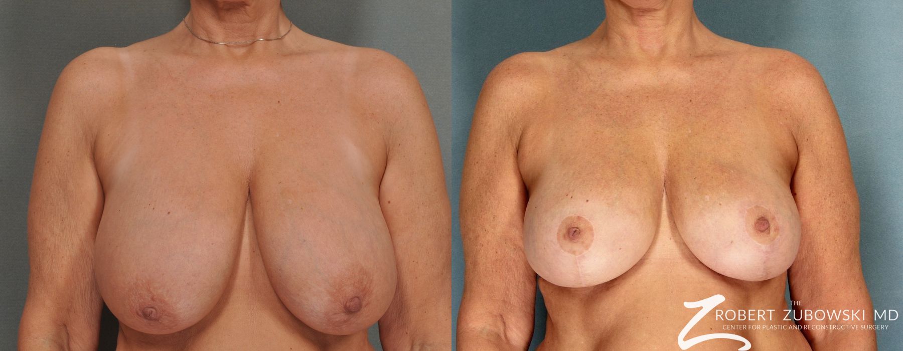 Breast Reduction - Case 3690