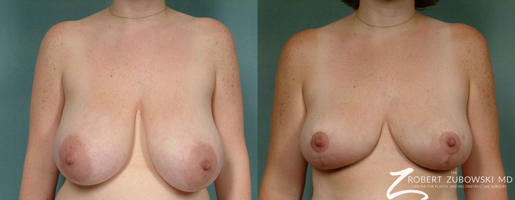 Breast Reduction - Case 3703