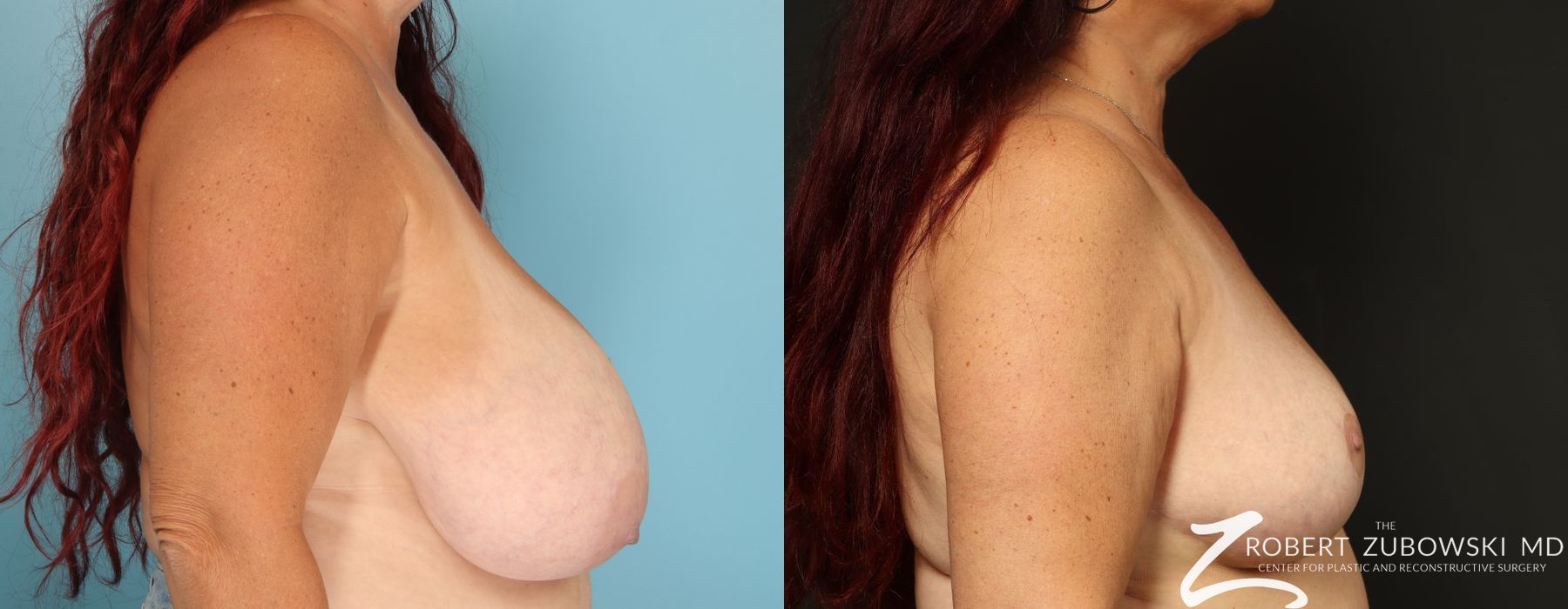 Breast Reduction - Thumbnail 2