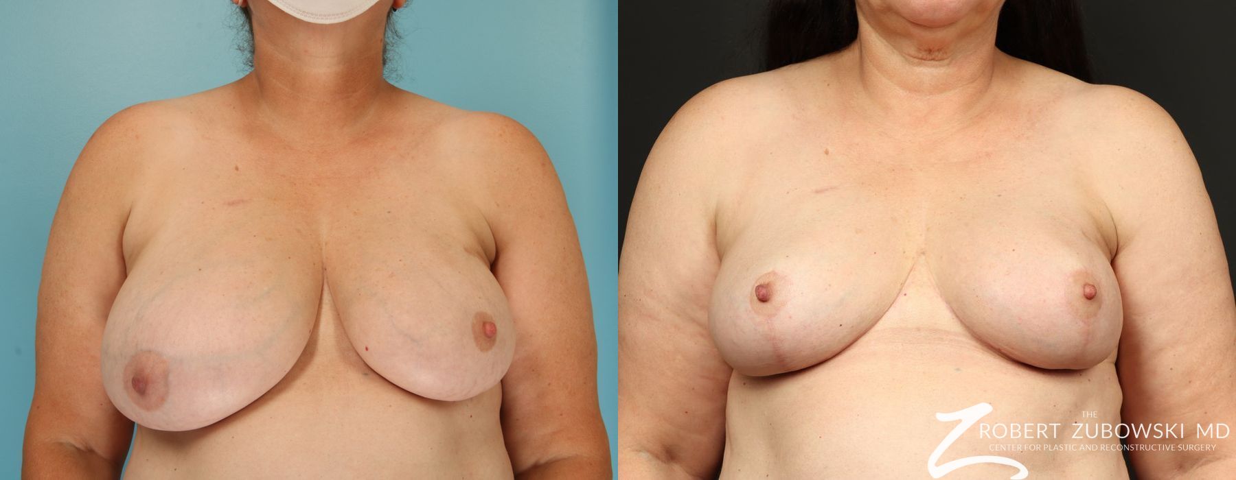 Breast Reduction - Case 3714