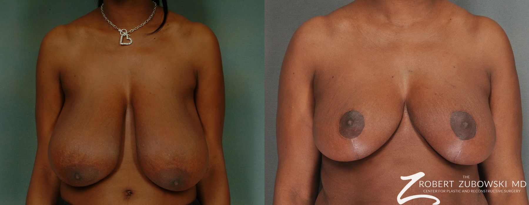 Breast Reduction - Case 3696