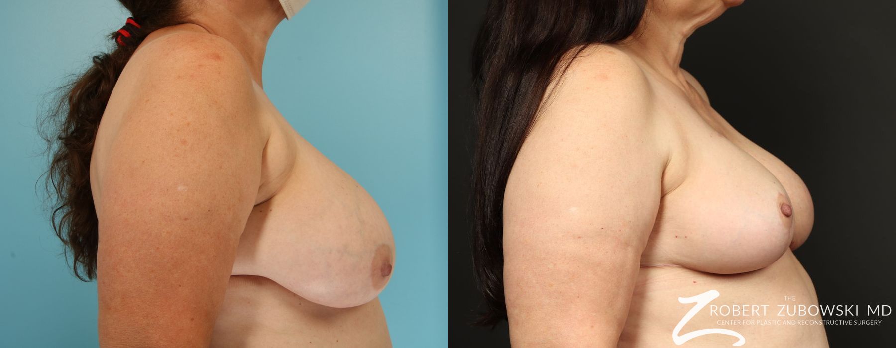 Breast Reduction - Thumbnail 3