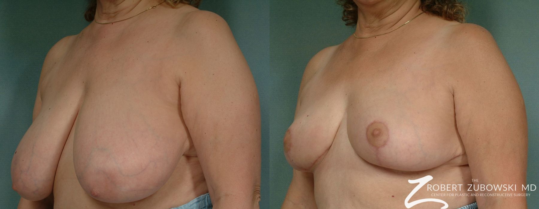 Breast Reduction - Thumbnail 2