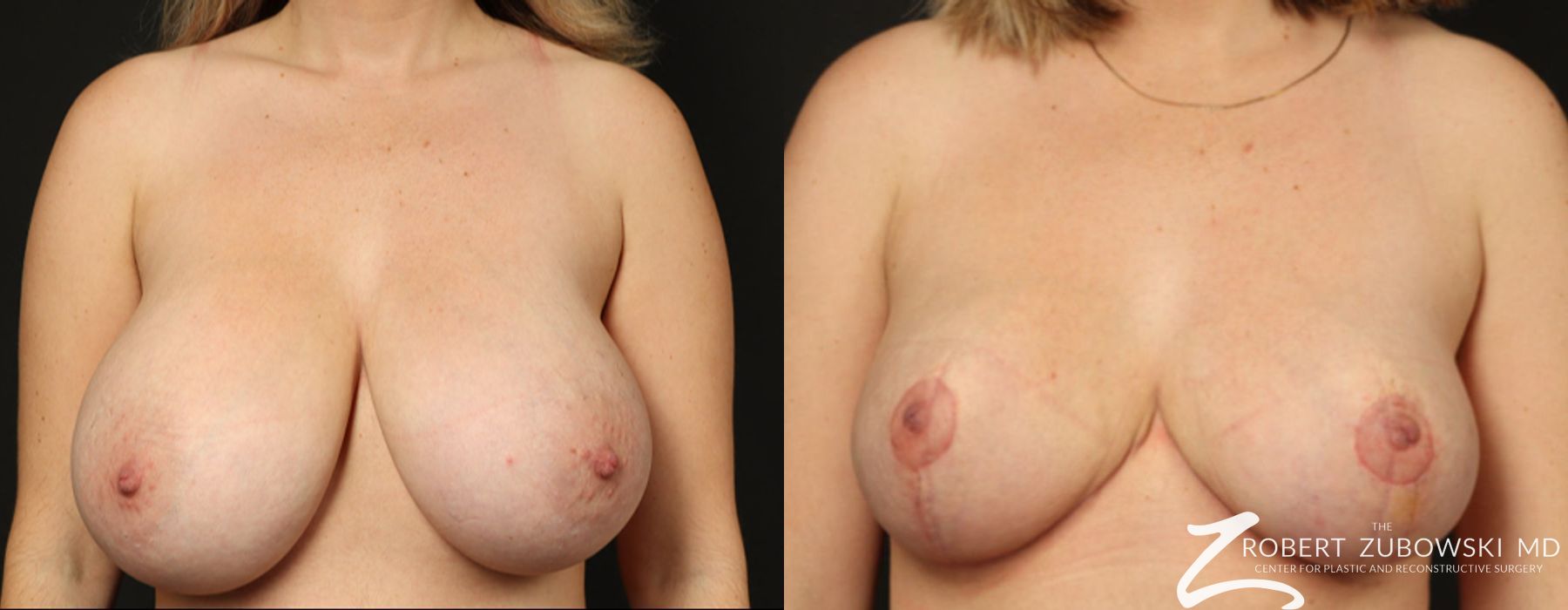 Breast Reduction - Case 3717