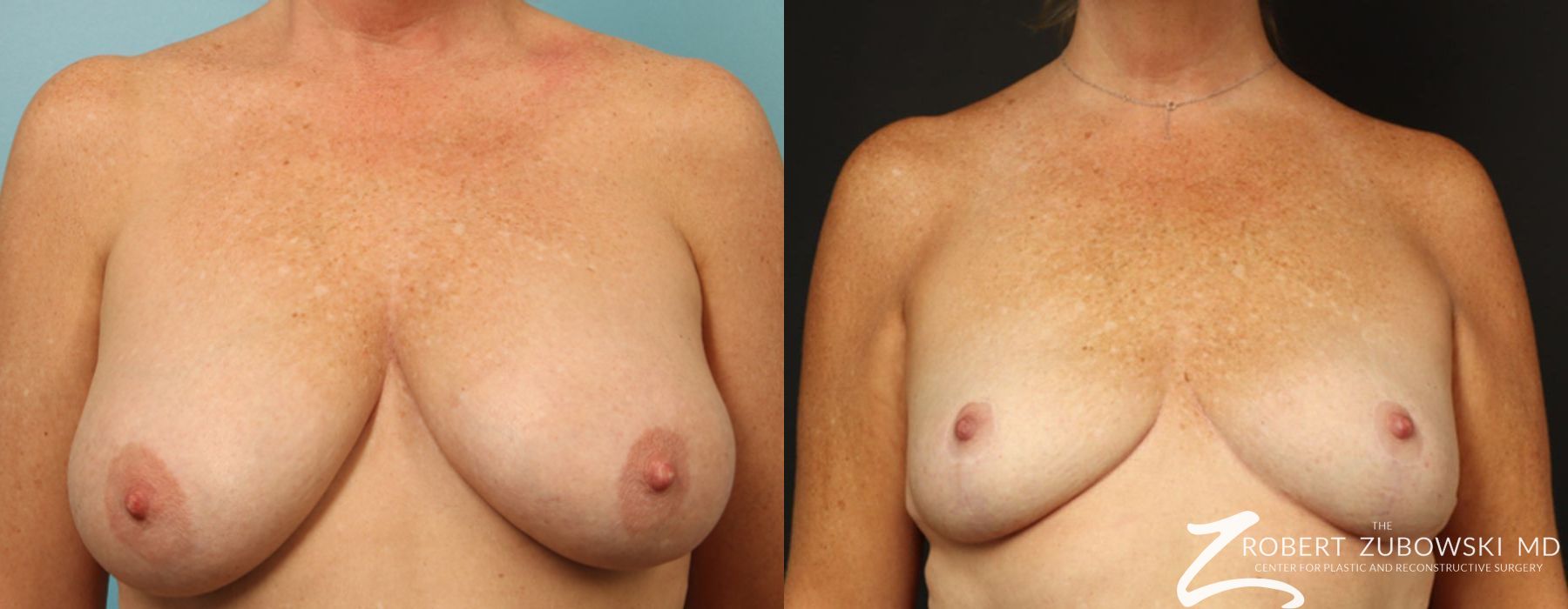 Breast Reduction - Case 3718
