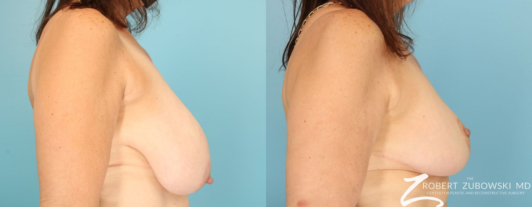 Breast Reduction - Thumbnail 2
