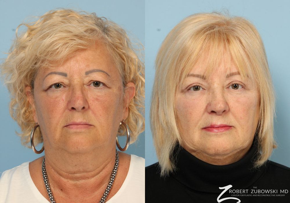 Brow Lift - Case 3787