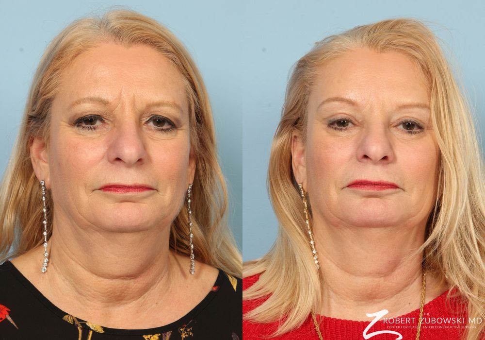 Brow Lift - Case 3790