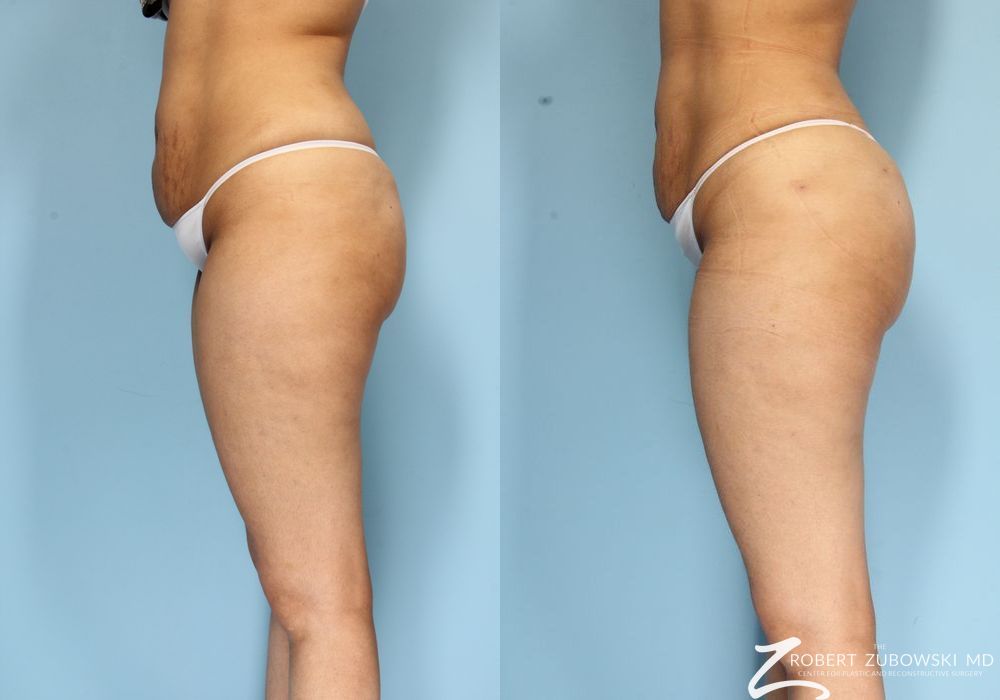 Butt Augmentation - Thumbnail 2