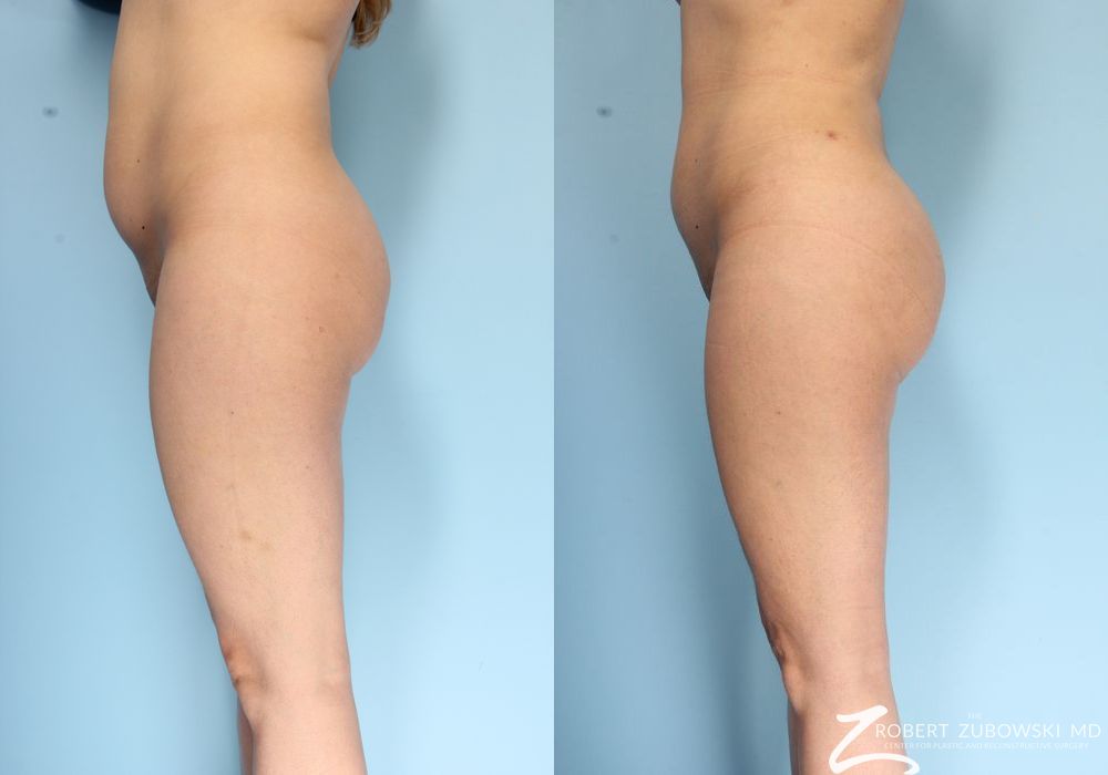 Butt Augmentation - Thumbnail 2