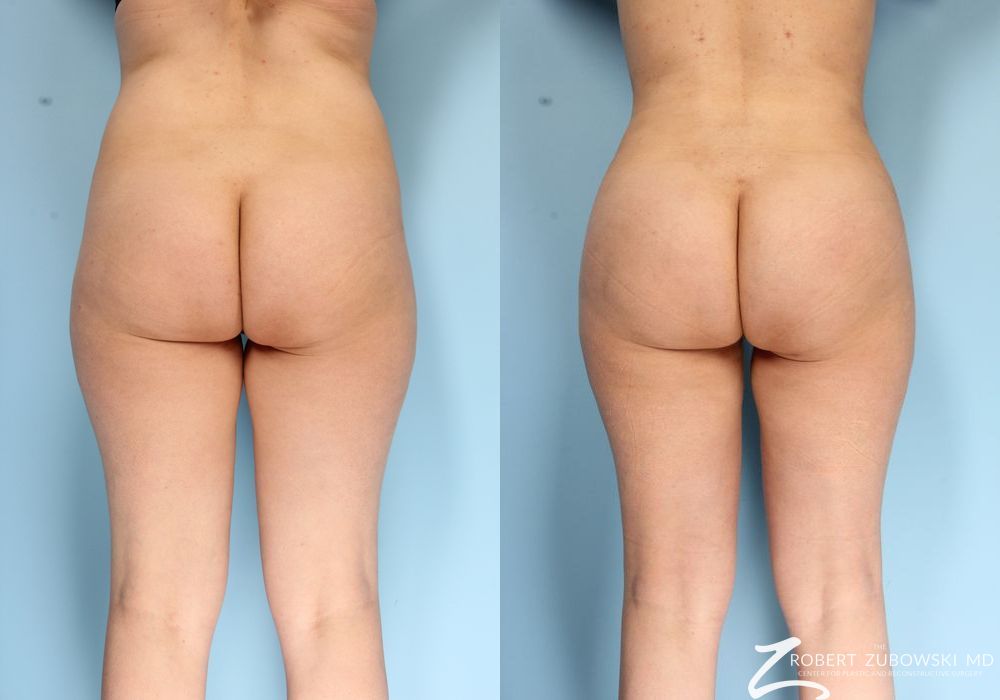 Butt Augmentation - Case 3519