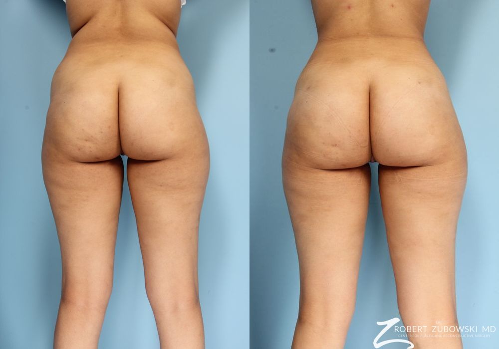 Butt Augmentation - Case 3520