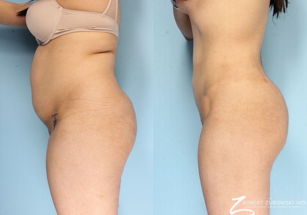 Butt Augmentation - Thumbnail 2