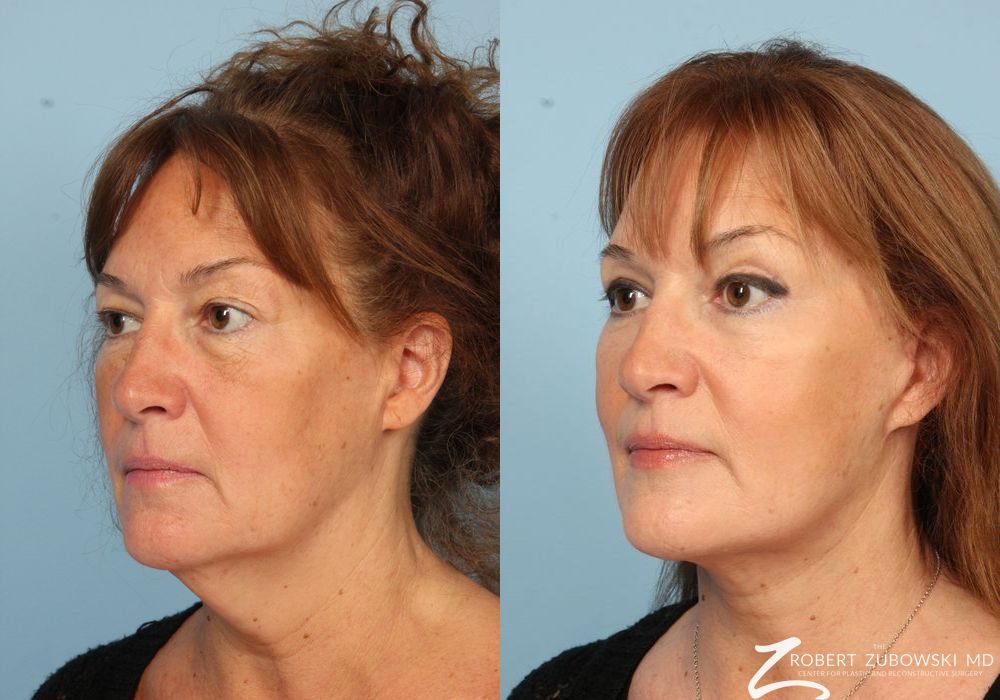 Chemical Peel - Thumbnail 2