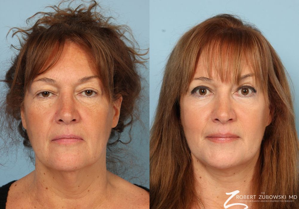 Chemical Peel - Case 3904