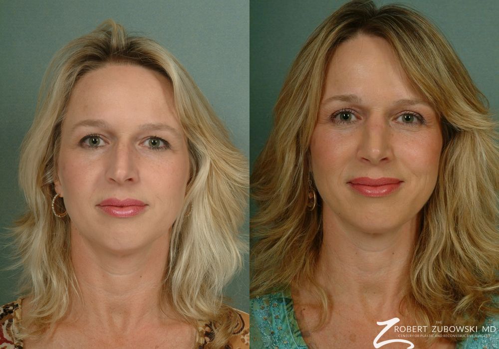 Chin Augmentation - Case 3793