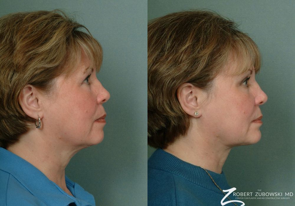 Chin Augmentation - Thumbnail 2