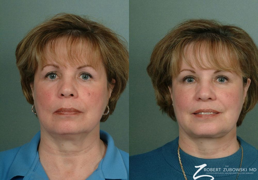 Chin Augmentation - Case 3792