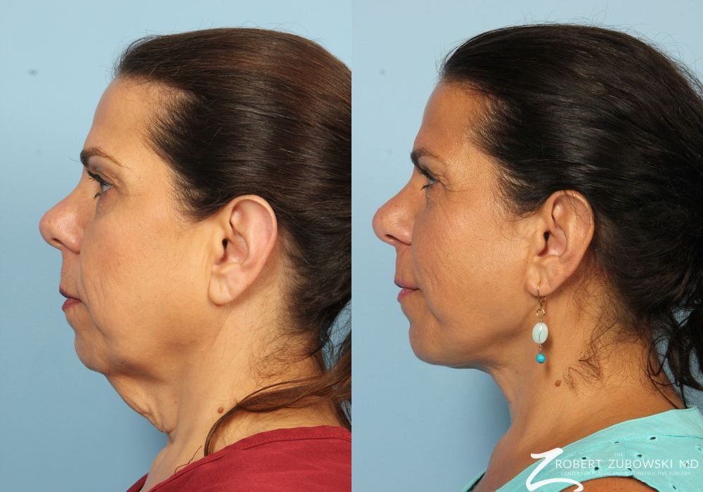 Chin Augmentation - Thumbnail 3