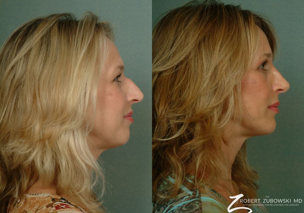 Chin Augmentation - Thumbnail 2