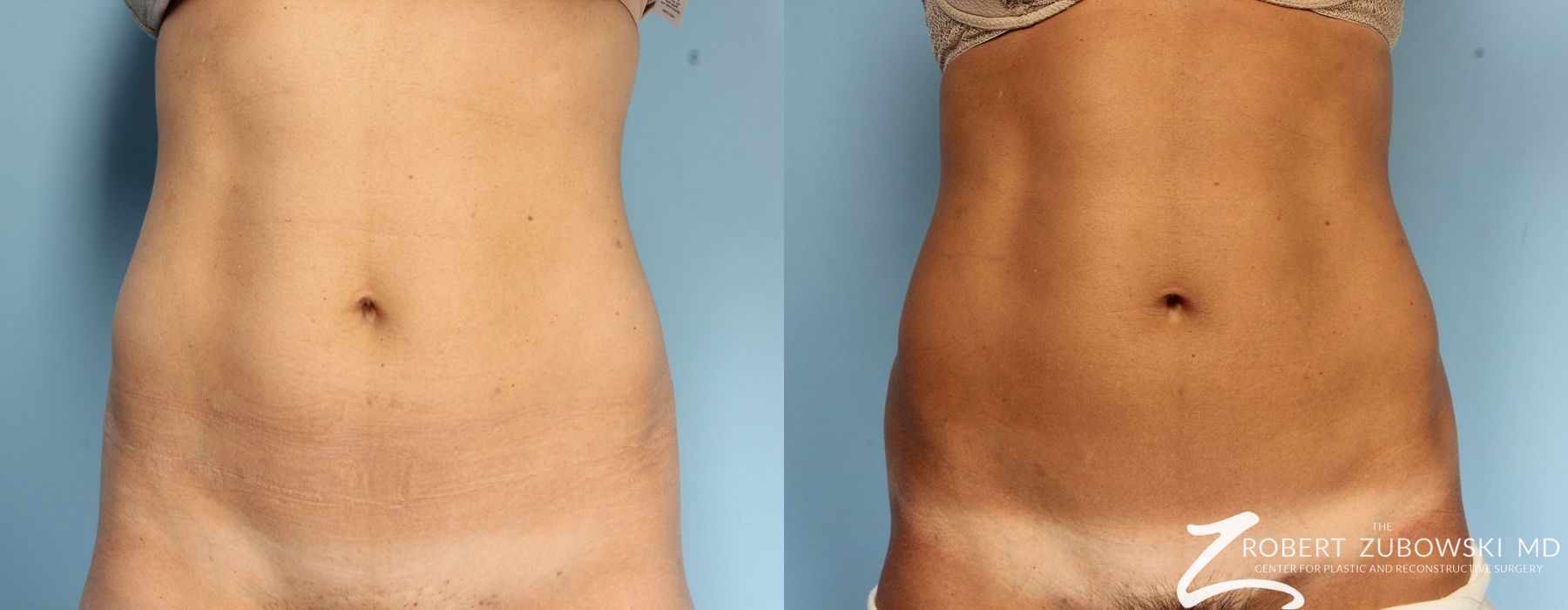 CoolSculpting® - Case 3909